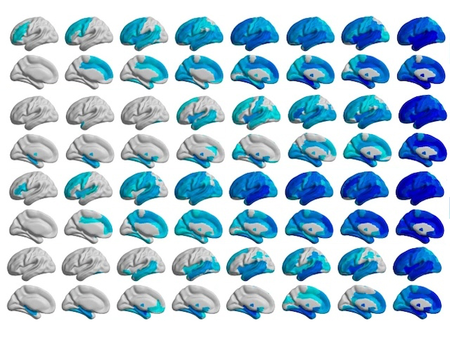 Patrons diferents de progressió patofisiològica d'un cervell amb esquizofrènia i altre sense en un context espaciotemporal
