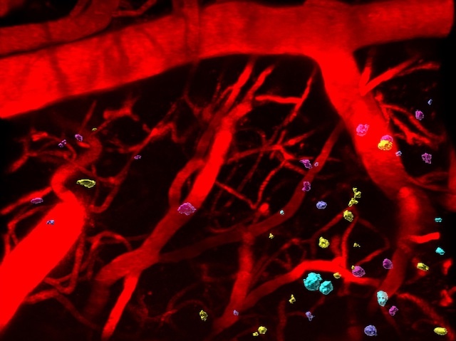 Neurones amb embolics de proteïna tau, destacant colors rojos, blaus, grocs i fúcsia