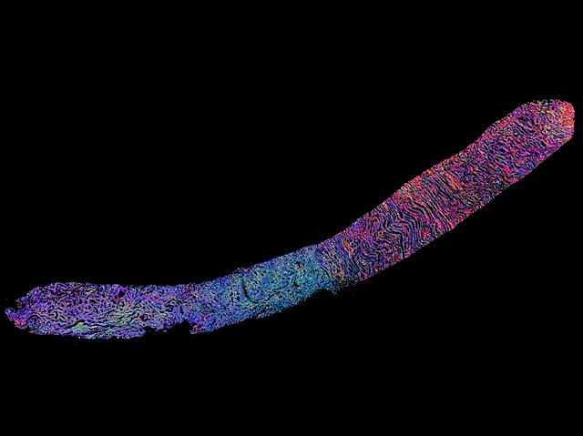 Teixit renal observat amb un nou mètode de tècniques d'imatge, mostra col·lagen en rosa i àcids grassos en verd