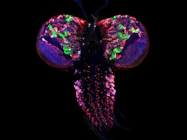 <p>Pèrdua de STAG2 i acumulació de cèl·lules tumorals amb relació a PARP1.</p>